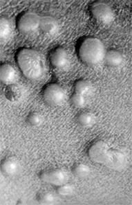 Close-up of smallpox pustules found on the thigh of a patient during the sixth day of the rash.